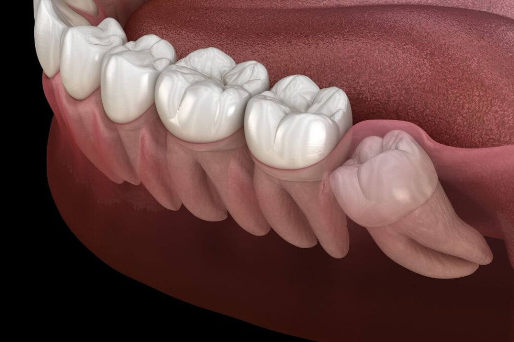 Denti del giudizio: quando crescono e quali possono essere le